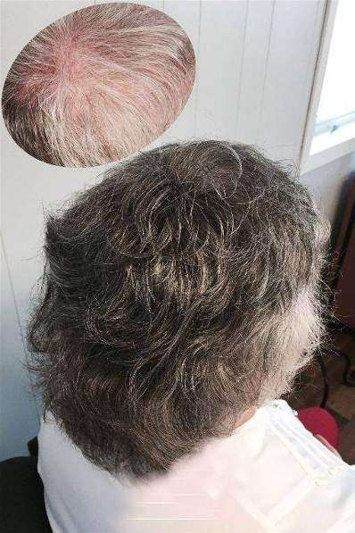 Indy Hair Loss | 2995 E Troy Ave, Beech Grove, IN 46107, USA | Phone: (317) 440-9355