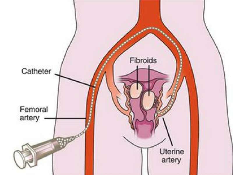 USA Fibroid Centers | 4141 Dundee Rd, Northbrook, IL 60062, USA | Phone: (847) 580-1312