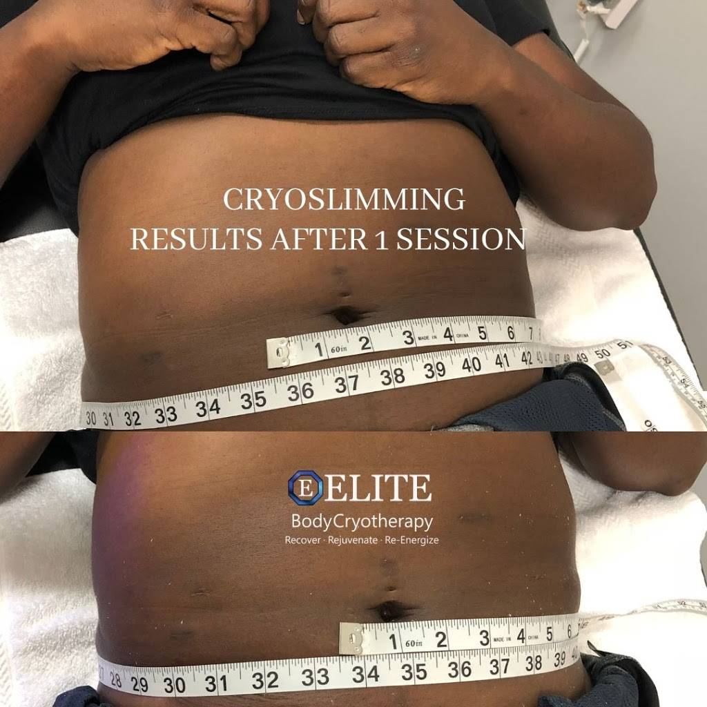 Cryoskin of St Petersburg (Cryo Slimming/Toning/Facial) and Ligh | 10692 Gandy Blvd N Suite 2, St. Petersburg, FL 33702, USA | Phone: (727) 575-7137