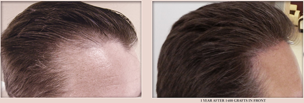 Advanced Hair Transplants | 2779 Sunridge Heights Pkwy #110, Henderson, NV 89052, USA | Phone: (702) 994-2133