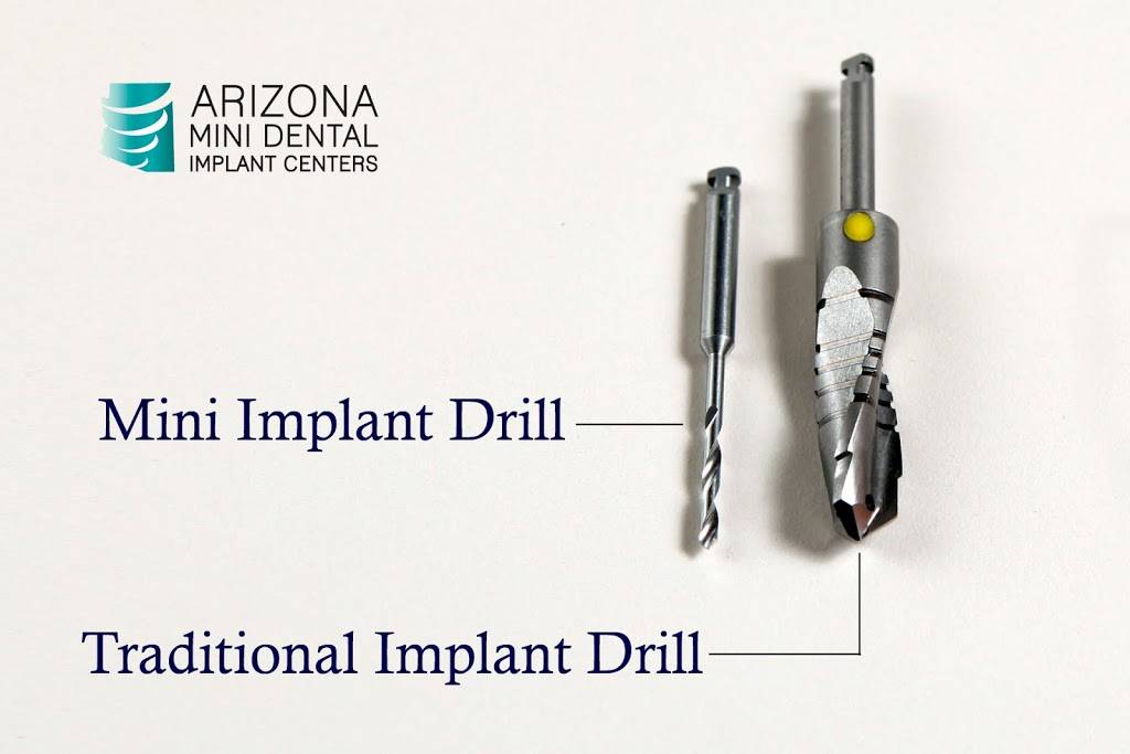Arizona Mini Dental Implant Center | 944 N Gilbert Rd, Mesa, AZ 85203, USA | Phone: (480) 898-3053