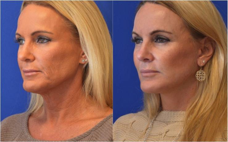 Facial Plastic Surgery Institute | 521 W Southlake Blvd #175, Southlake, TX 76092, USA | Phone: (817) 328-8380