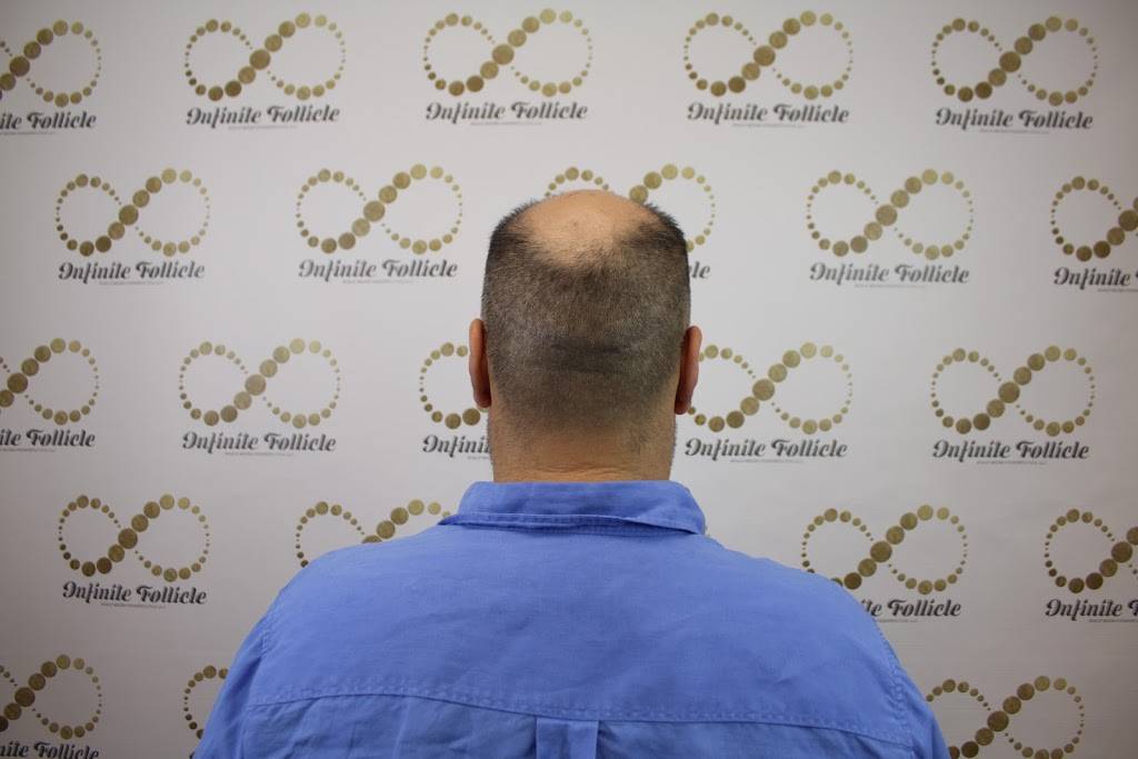 Infinite Follicle Scalp MicroPigmentation LLC. | 2200 E River Rd #125, Tucson, AZ 85718, USA | Phone: (520) 809-2188