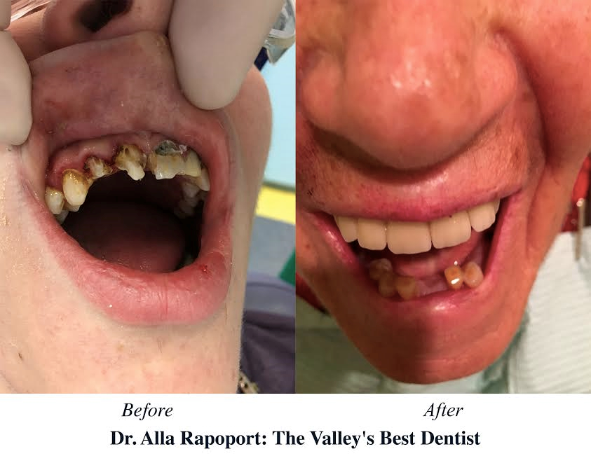 Alla Rapoport DDS | 7601 Canby Ave Suite 4, Reseda, CA 91335 | Phone: (818) 774-9933