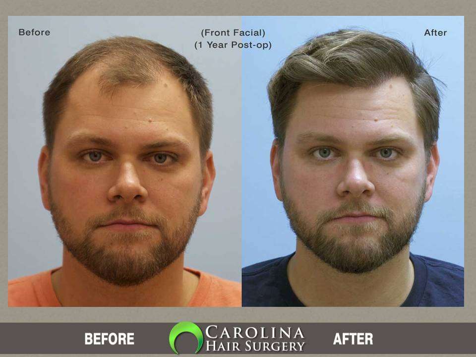 Carolina Hair Surgery: FUE Hair Transplant | 1021 Maxwell Mill Rd, Fort Mill, SC 29708, USA | Phone: (803) 217-3065