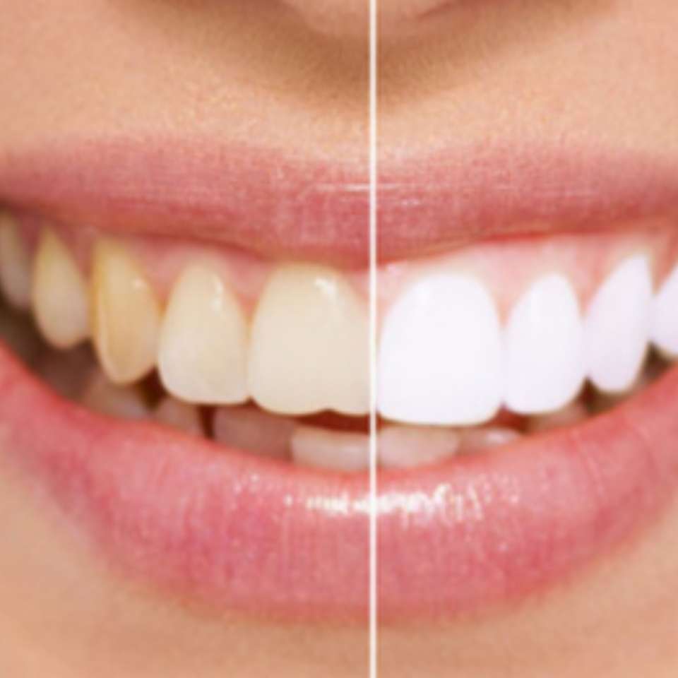 Luxury Bright White Smile | Los Angeles, CA 90027, USA | Phone: (213) 377-2700