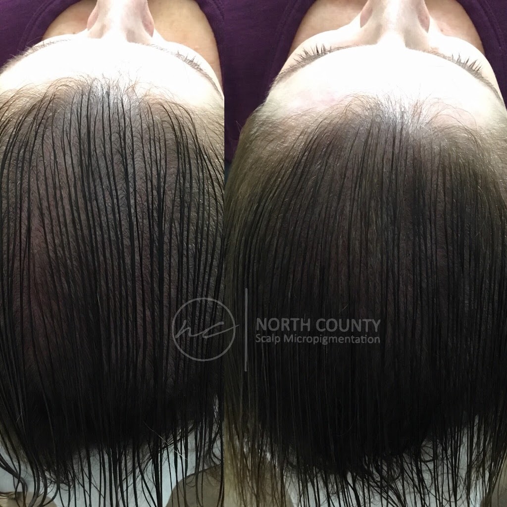 North County Scalp Micropigmentation | 1172, 1822 Marron Rd, Carlsbad, CA 92008, USA | Phone: (760) 805-6801