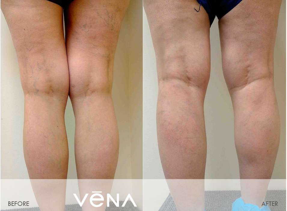 Vena Vascular Pasadena | 333 N Hill Ave, Pasadena, CA 91106, USA | Phone: (626) 449-9922