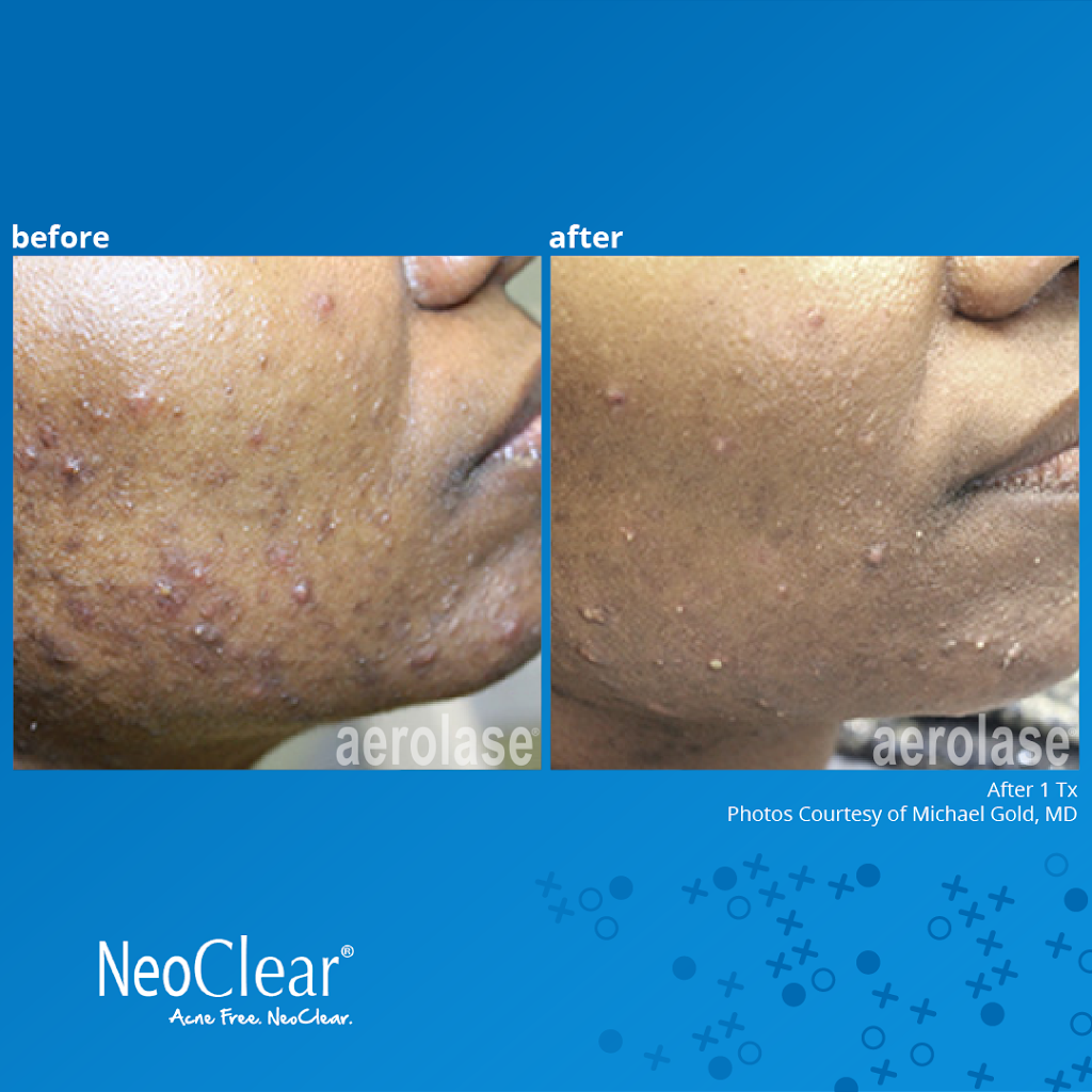 Clarity Acne & Aesthetic Dermatology | 3345 Bridge Rd Ste 900, Suffolk, VA 23435, USA | Phone: (757) 250-7986