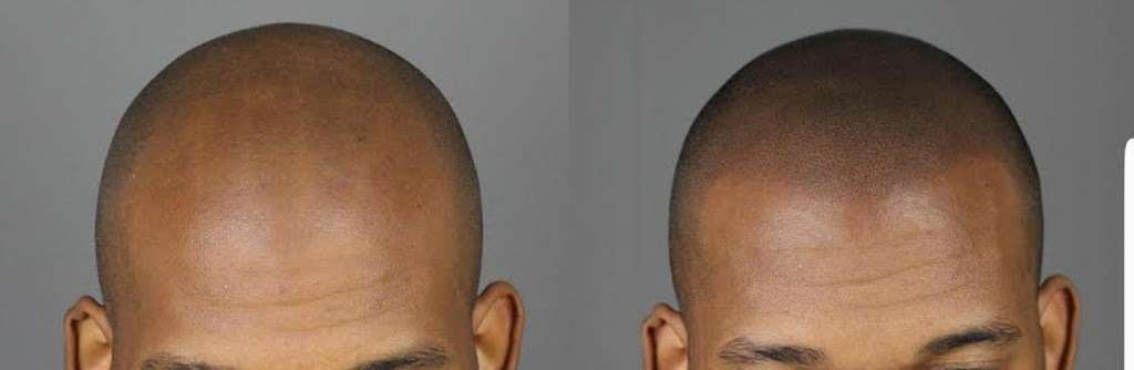 Pro Scalp Pigmentation | 18701 Curry Powder Ln, Germantown, MD 20874, USA | Phone: (301) 969-8850