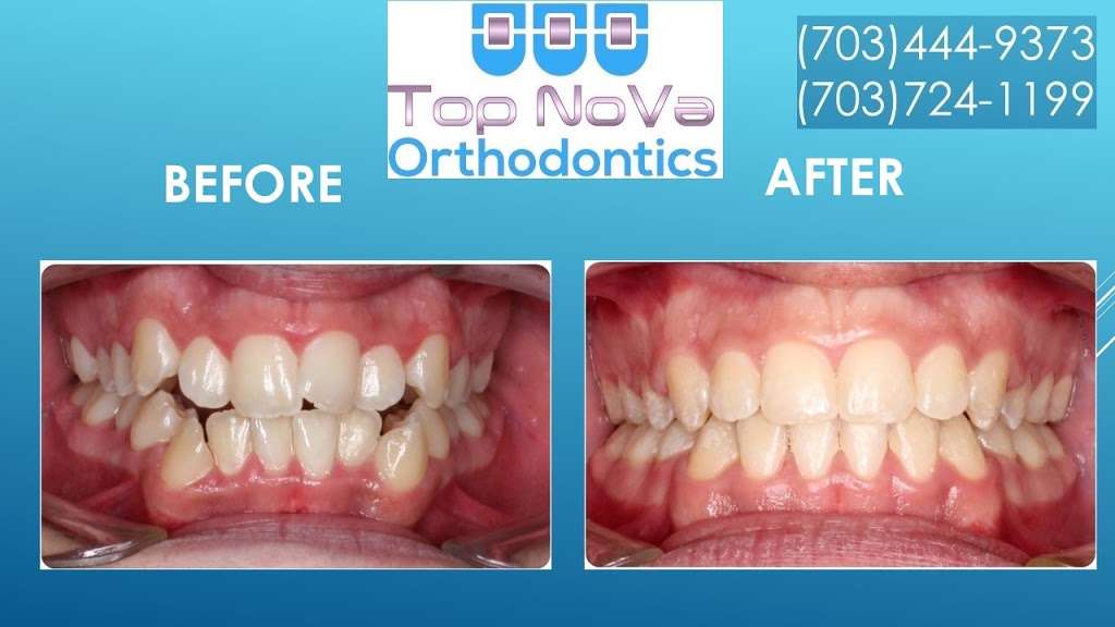 Top Nova Orthodontics | 43170 Southern Walk Plaza # 104, Ashburn, VA 20148, USA | Phone: (703) 724-1199
