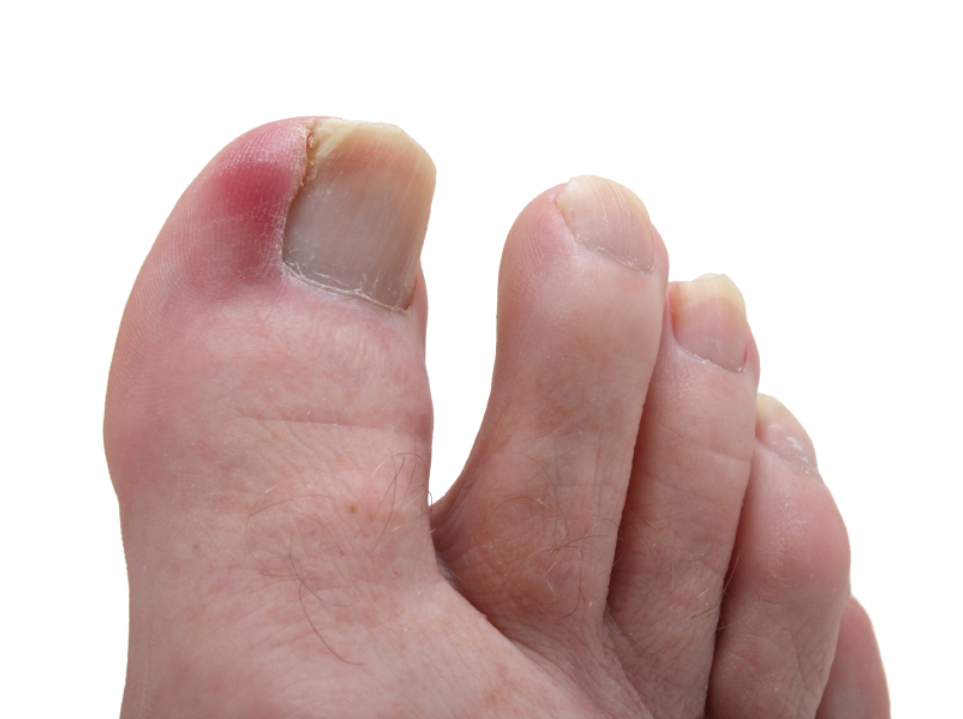 Ingrown Toenail Treatment in Toenail Fungus Treatment Center | 844 W Glenoaks Blvd, Glendale, CA 91202, USA | Phone: (424) 299-4627