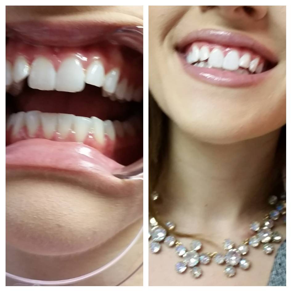 Malibu Teeth Whitening-Parham Medical Village- | 2103 E Parham Rd #204, Richmond, VA 23228, USA | Phone: (804) 629-3390