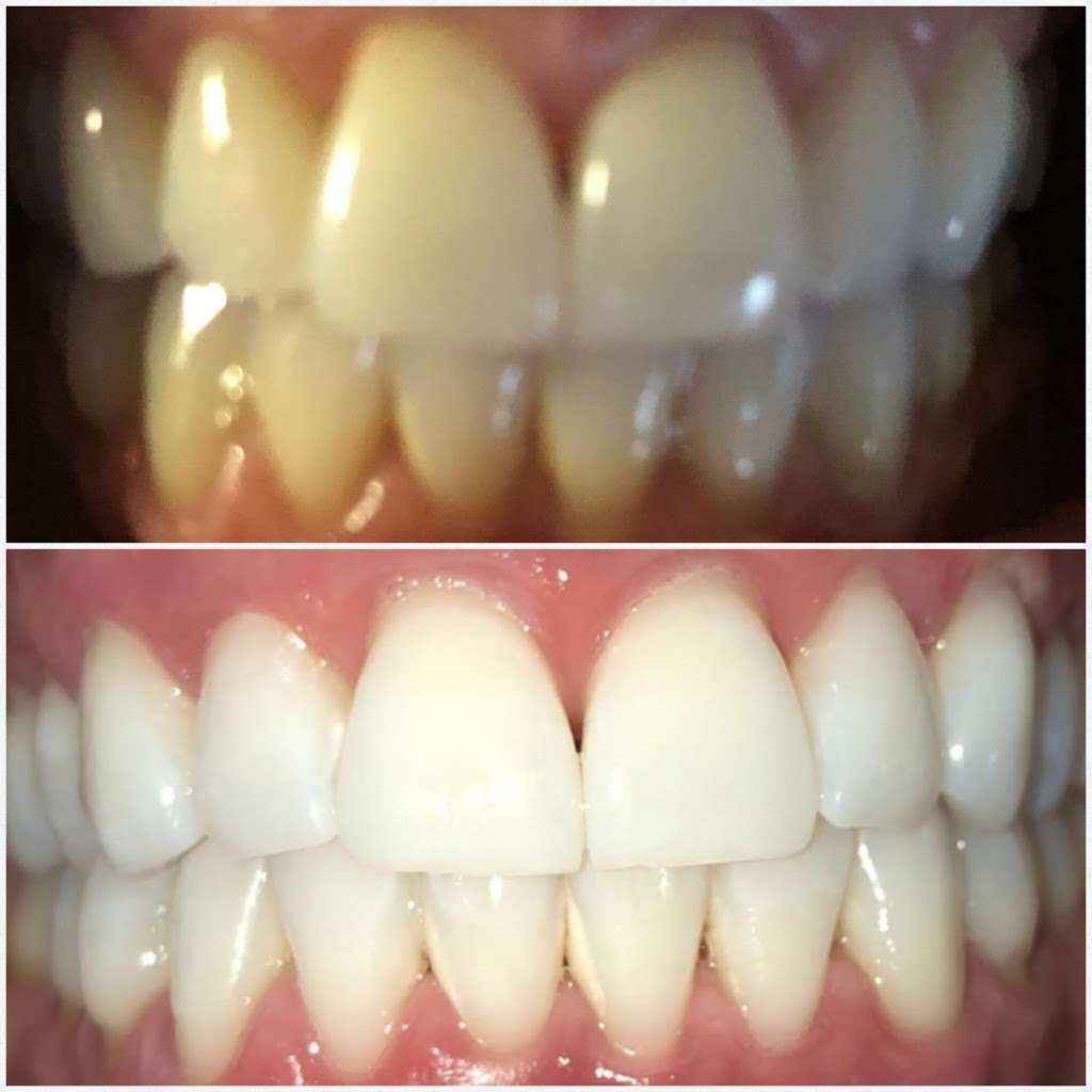 Yevonne’s laser teeth whitening LLC | 4933 S Carson St APT 212, Aurora, CO 80015, USA | Phone: (720) 629-9030