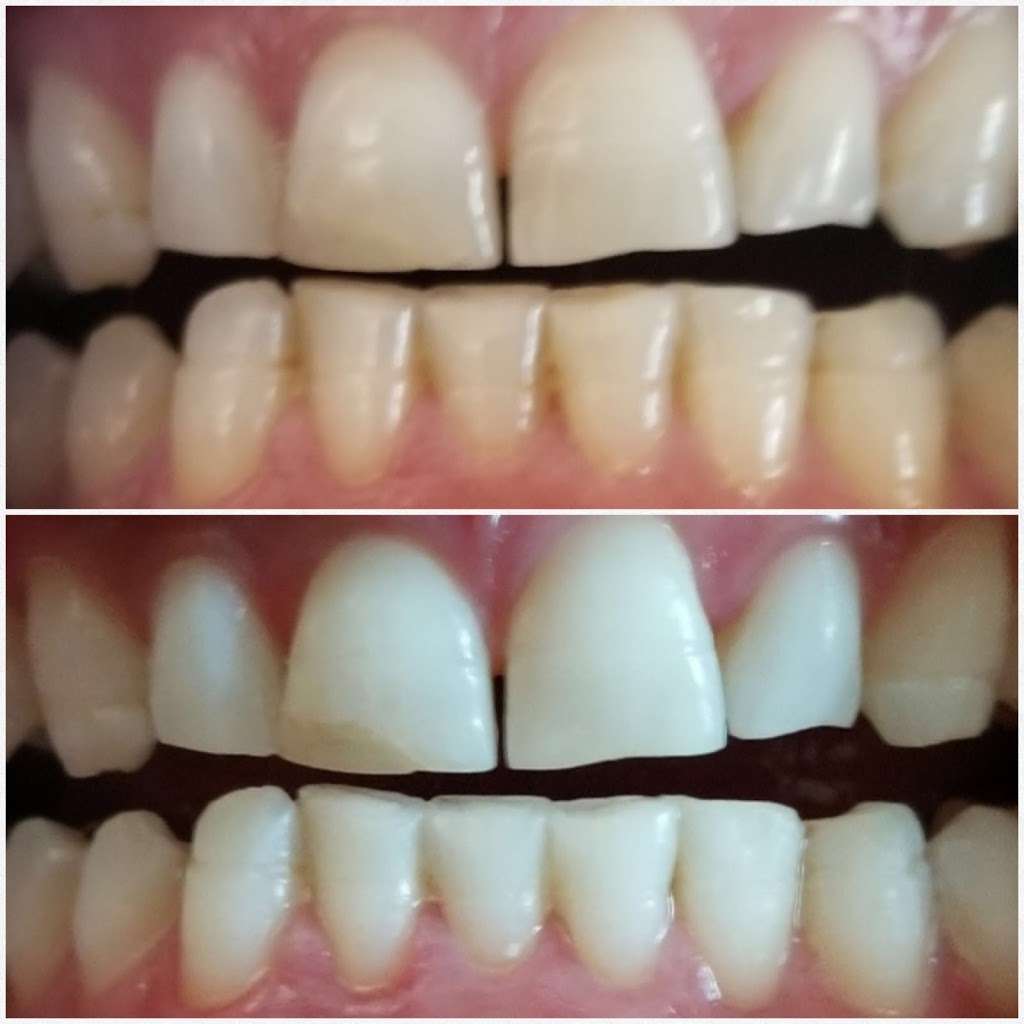 Yevonne’s laser teeth whitening LLC | 4933 S Carson St APT 212, Aurora, CO 80015, USA | Phone: (720) 629-9030