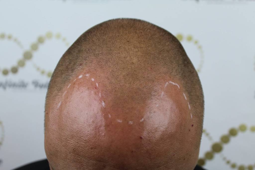 Infinite Follicle Scalp MicroPigmentation LLC. | 2200 E River Rd #125, Tucson, AZ 85718, USA | Phone: (520) 809-2188