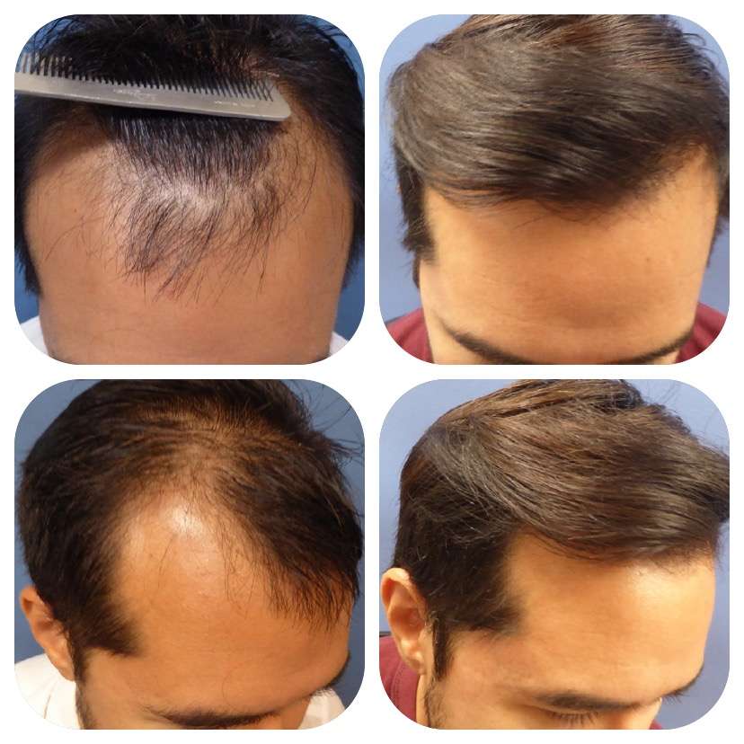 Meshkin Medical - Cosmetic Hair Restoration and Hair Transplant  | 912 W Glenoaks Blvd, Glendale, CA 91202, USA | Phone: (800) 246-8424