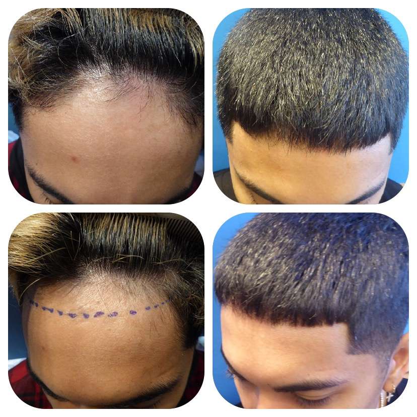 Meshkin Medical - Cosmetic Hair Restoration and Hair Transplant  | 912 W Glenoaks Blvd, Glendale, CA 91202, USA | Phone: (800) 246-8424