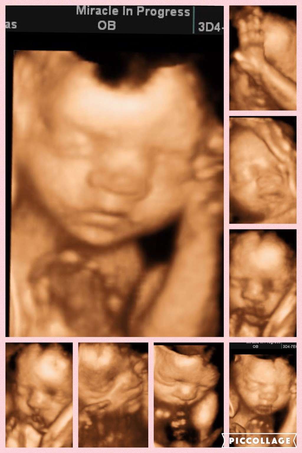 Miracle In Progress 3d 4d Ultrasound Studio Early Gender Deter