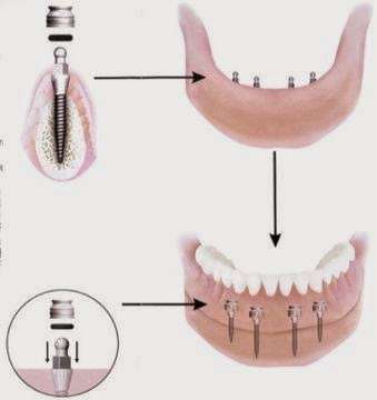 Mini Dental Implant Center Polk City, FL | 120 Carter Blvd #7, Polk City, FL 33868, USA | Phone: (863) 984-0000