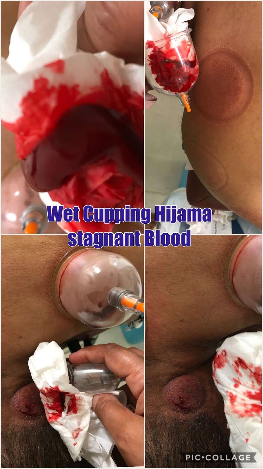 SHAAFI HIJAMA CUPPING CENTER | 4213 Birch Colony Ct, Porter, TX 77365, USA | Phone: (281) 508-4249