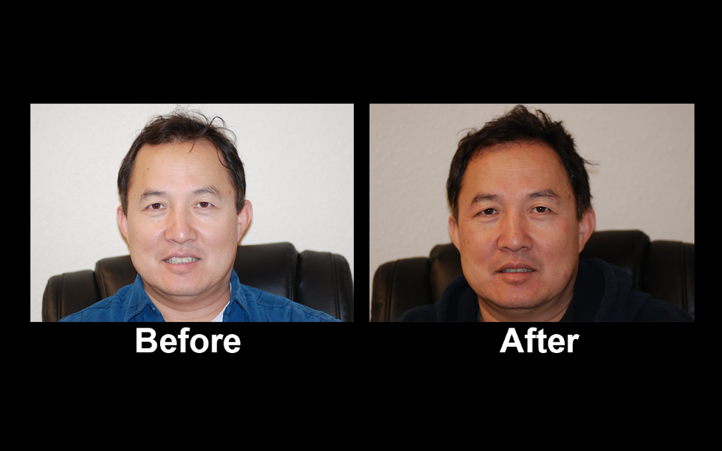 Halby Hair Transplant, Ltd. | 5524 S Fort Apache Rd Suite #100, Las Vegas, NV 89148, USA | Phone: (702) 258-6229