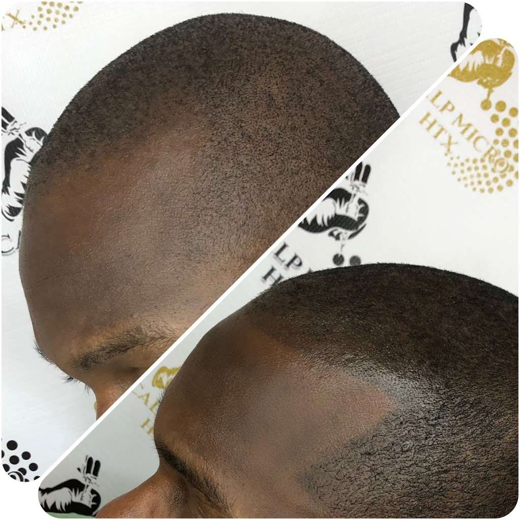 Scalp Micro HTX | 6510 Bellfort St C, Houston, TX 77087, USA | Phone: (832) 303-1722