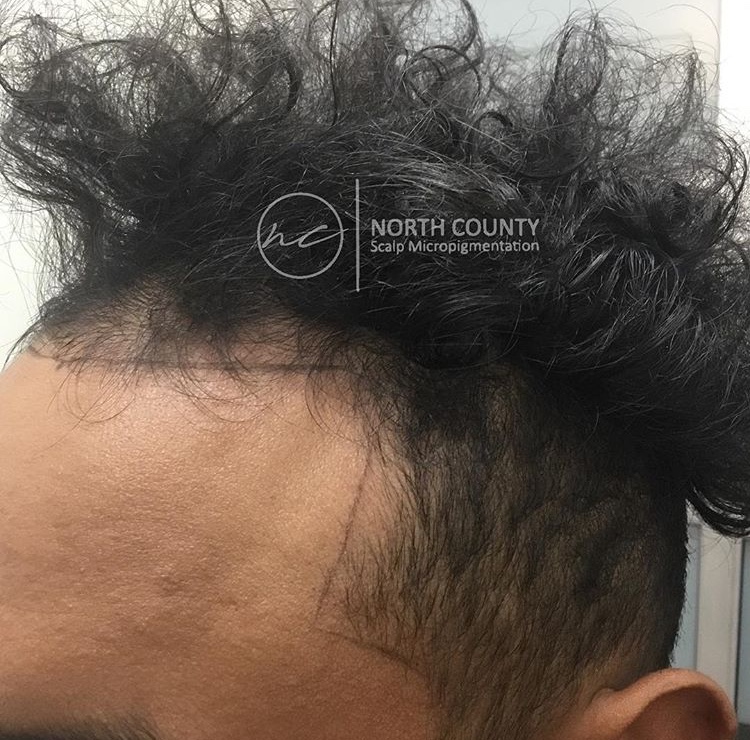 North County Scalp Micropigmentation | 1172, 1822 Marron Rd, Carlsbad, CA 92008, USA | Phone: (760) 805-6801