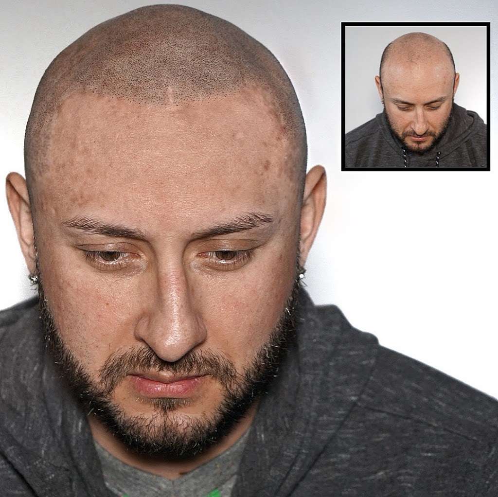 Picasso Scalp Micropigmentation - Chicago | 7550 Archer Rd unit b, Justice, IL 60458, USA | Phone: (480) 547-6246