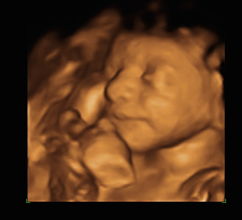 My Sweet Baby 3D/4D Ultrasounds | 5530 25th St, Columbus, IN 47203 | Phone: (812) 260-1881