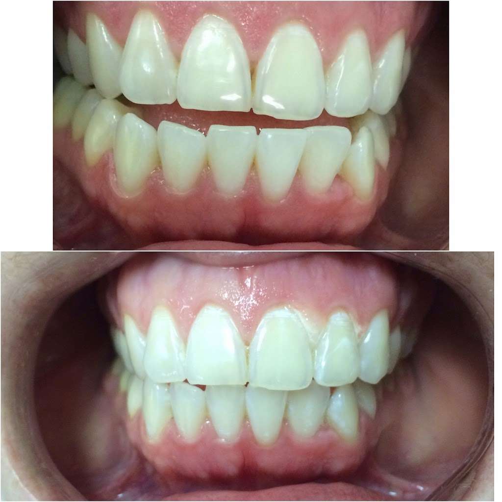Lumin Teeth Whitening | 12841 Jones Rd #208, Houston, TX 77070, USA | Phone: (281) 463-4601