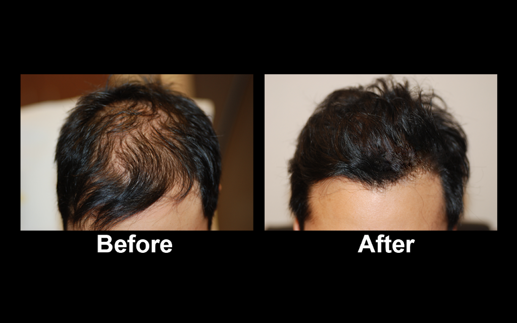 Halby Hair Transplant, Ltd. | 5524 S Fort Apache Rd Suite #100, Las Vegas, NV 89148, USA | Phone: (702) 258-6229