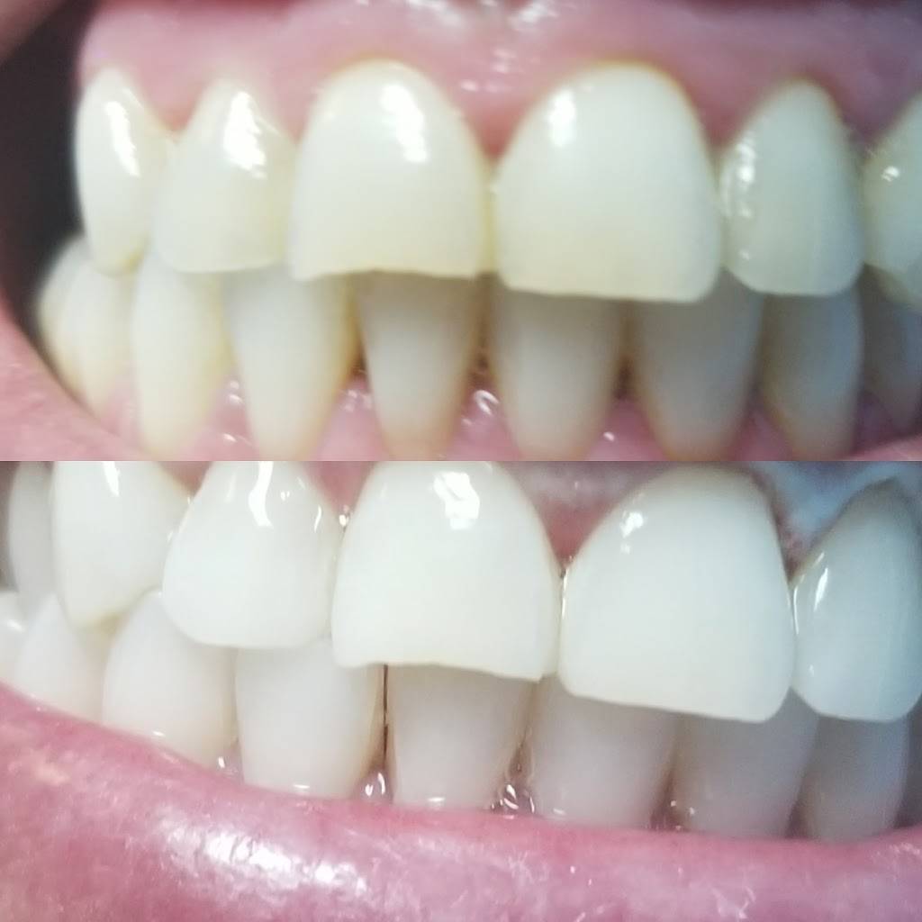 Radiant White Smiles Of Austin Cosmetic Teeth Whitening | Suite 500, 9900 S IH 35 Frontage Rd Bldg 0, Austin, TX 78748, USA | Phone: (512) 566-7209