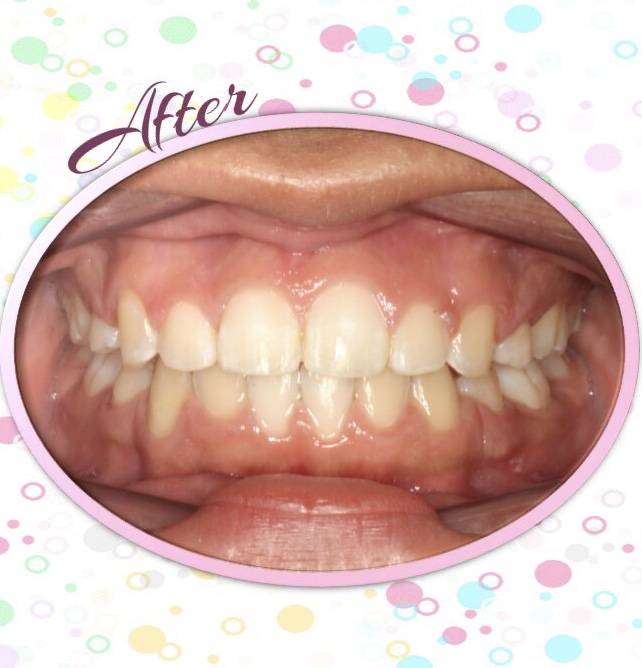 CC Braces | 5525 S Staples St building c, Corpus Christi, TX 78411, USA | Phone: (361) 992-4746