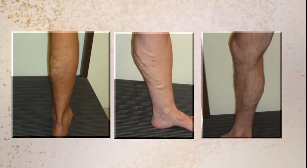 Rosen Vein Care: Dr. David Ian Rosen | 1535 Lake Cook Rd Ste 401, Northbrook, IL 60062, USA | Phone: (847) 272-8346