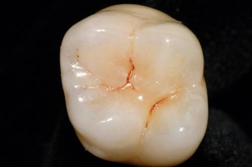 ZirCad Prime / 3M™ Lava™ Esthetic Fluorescent Full-Contour "Zirconia Crowns" | smiledesignerlab@outlook.com HT Dental Studio 6085, Water St #2405, Plano, TX 75024, USA | Phone: (214) 288-1509