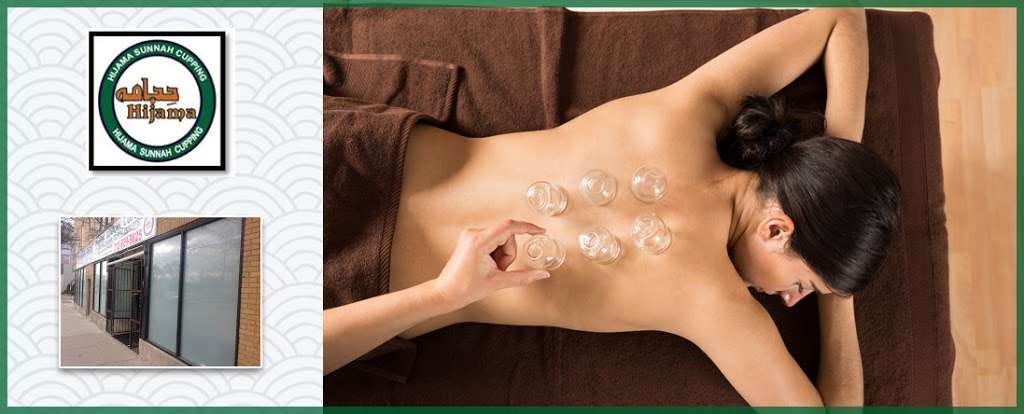 Hijama Sunnah Cupping | 2122 W Devon Ave, Chicago, IL 60659, USA | Phone: (312) 929-9825