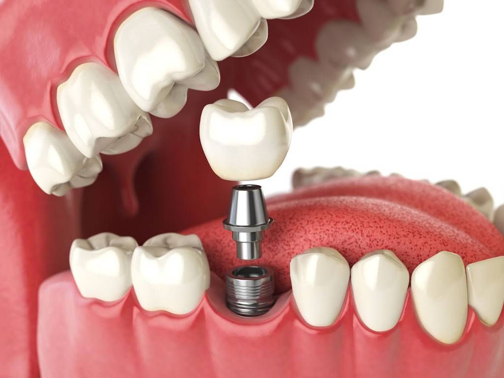 Tooth Implant Brooklyn | 2384 Ocean Ave suite 170, Brooklyn, NY 11229 | Phone: (718) 701-6433