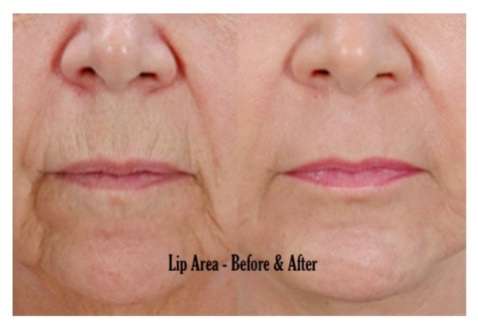 Plasma Skin Lifting NY | 5625 Post Rd #1, The Bronx, NY 10471, USA | Phone: (646) 377-0448