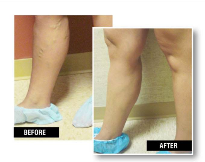 USA Vein Clinics | 2 Robinson Plaza Ste 310, Pittsburgh, PA 15205, USA | Phone: (878) 203-9330