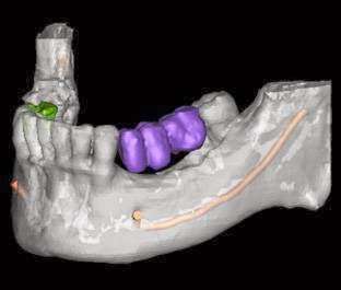 Amalia Dental Group / Dental Implants | 528 Amalia Ave, Los Angeles, CA 90022, USA | Phone: (323) 488-3366