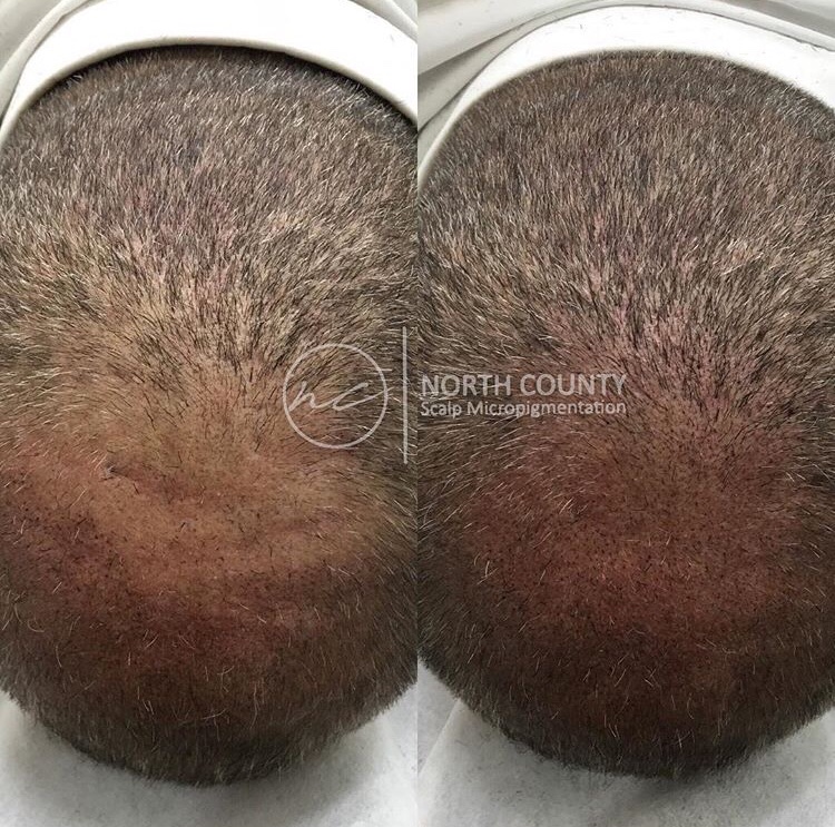 North County Scalp Micropigmentation | 1172, 1822 Marron Rd, Carlsbad, CA 92008, USA | Phone: (760) 805-6801