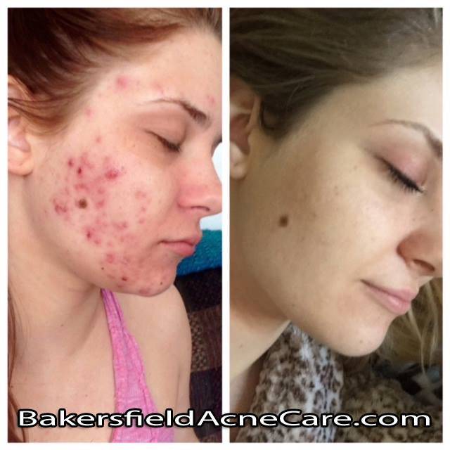 Bakersfield Acne Care | 2120 24th St #1, Bakersfield, CA 93301, USA | Phone: (661) 319-3568