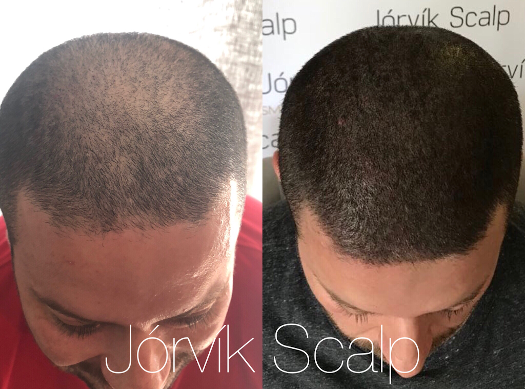 Jorvik Aesthetics - Houston Scalp Micropigmentation (SMP) | 4101 Greenbriar Dr #240, Houston, TX 77098, USA | Phone: (832) 793-9151