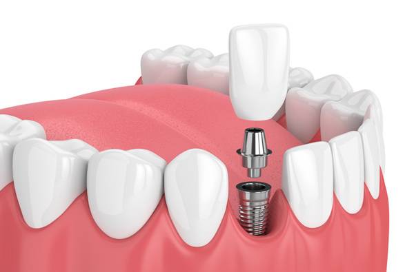 Periodontics and Dental Implants of North Carolina | 6101 Grace Park Dr, Morrisville, NC 27560 | Phone: (919) 493-9900