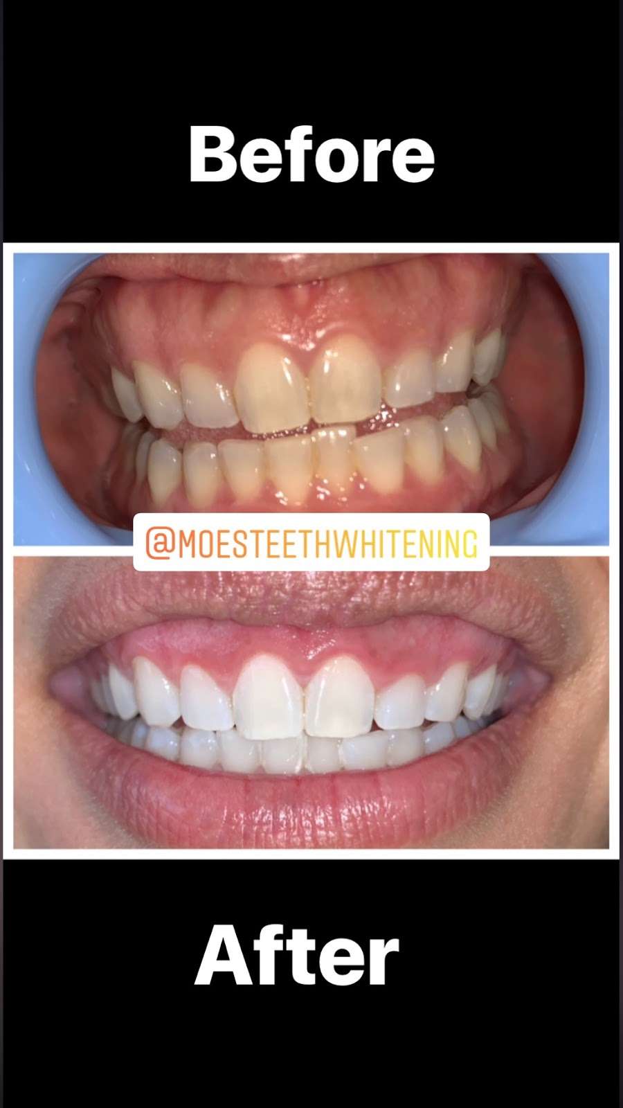 Moes Teeth Whitening | 1530 Jamacha Rd. #X, El Cajon, CA 92019, USA | Phone: (619) 922-1280