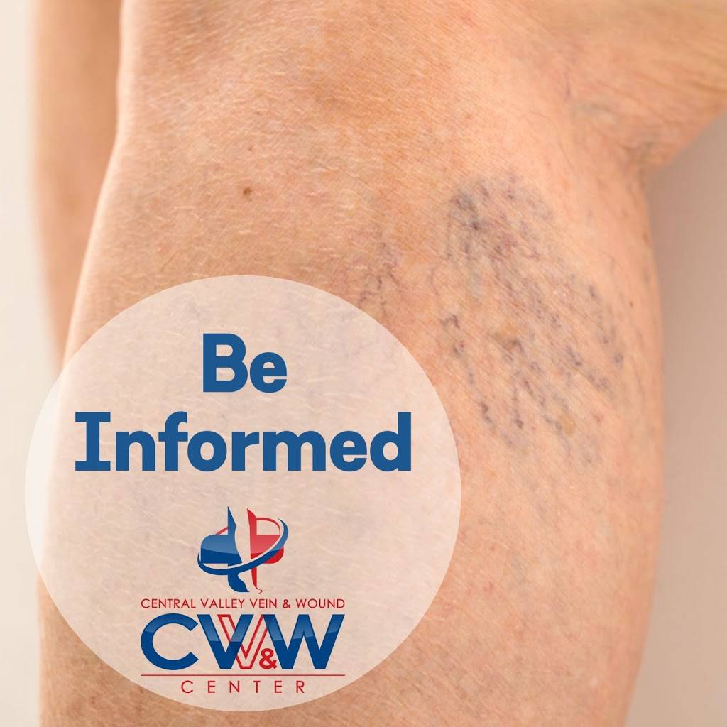 Central Valley Vein And Wound Center | 1850 Floral Ave, Selma, CA 93662 | Phone: (559) 721-4910