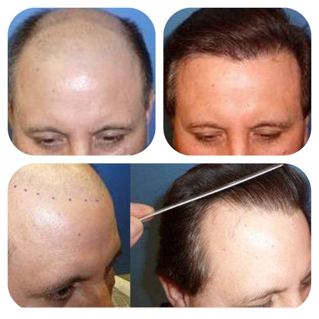 Meshkin Medical - Cosmetic Hair Restoration and Hair Transplant  | 912 W Glenoaks Blvd, Glendale, CA 91202, USA | Phone: (800) 246-8424