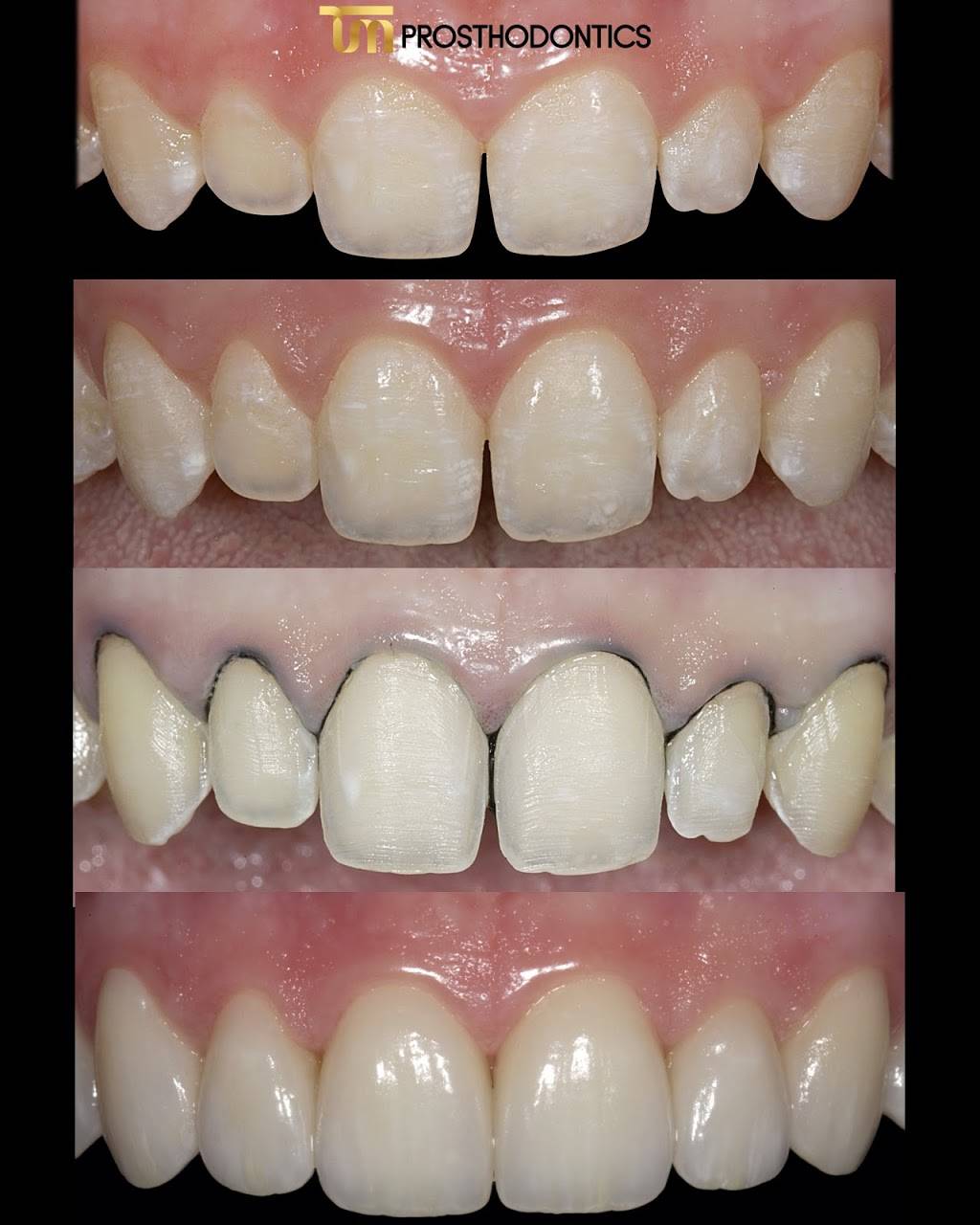 TM Prosthodontics - Dr. Tal Morr | 20760 W Dixie Hwy, Miami, FL 33180, USA | Phone: (305) 935-6066