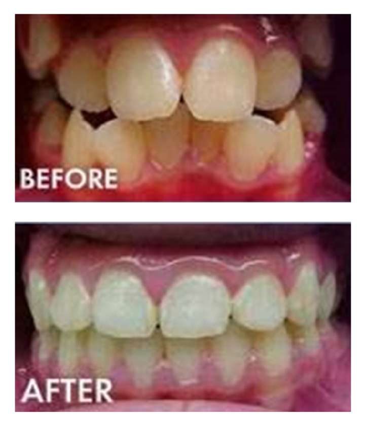 Cool Smiles Orthodontics - Colton | 1130 N Pepper Ave, Colton, CA 92324, USA | Phone: (909) 422-0007